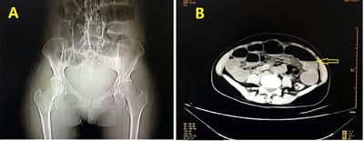 Ileal adenocarcinoma in a young pregnant woman: A rare case report